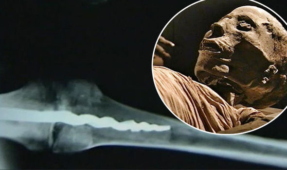 Evidence of Ancient Egyptian Surgery: Prosthetic Pin Discovered in Mummy Dating Back 3000 Years